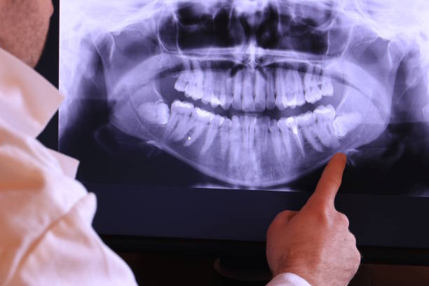 Best Emergency Tooth Extraction in Norco, CA