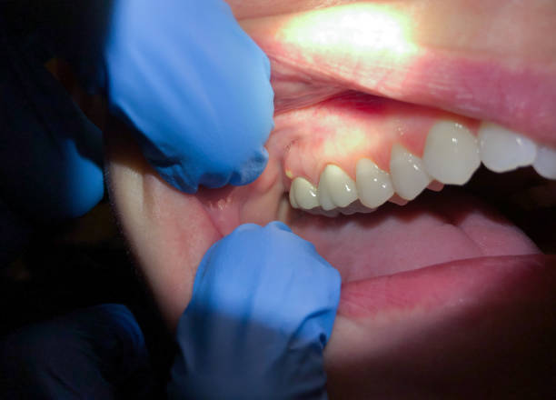 Best Emergency Treatment for Dental Infections or Abscesses in Norco, CA