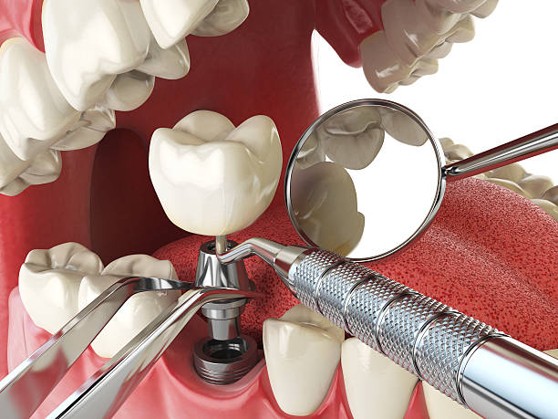 Best Emergency Root Canal Treatment in Norco, CA